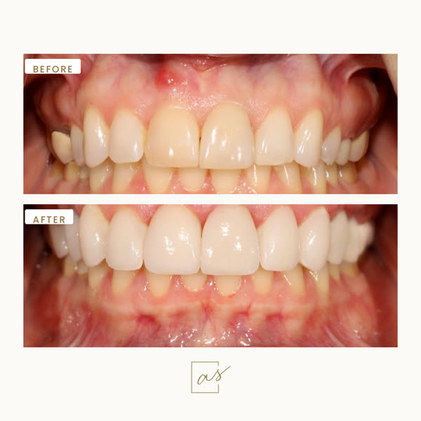 Smile Makeover Before & After Gallery - Patient 1 - Image 1