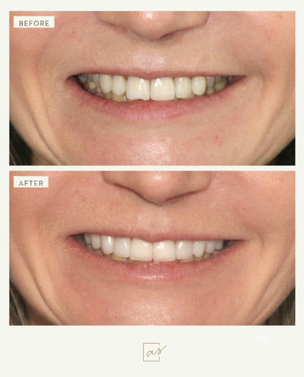Smile Makeover Before & After Gallery - Patient 3 - Image 2