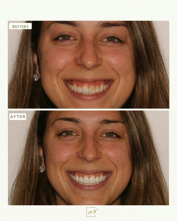 Smile Makeover Before & After Gallery - Patient 4 - Image 1