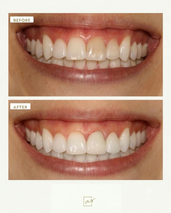 Smile Makeover Before & After Gallery - Patient 8 - Image 1