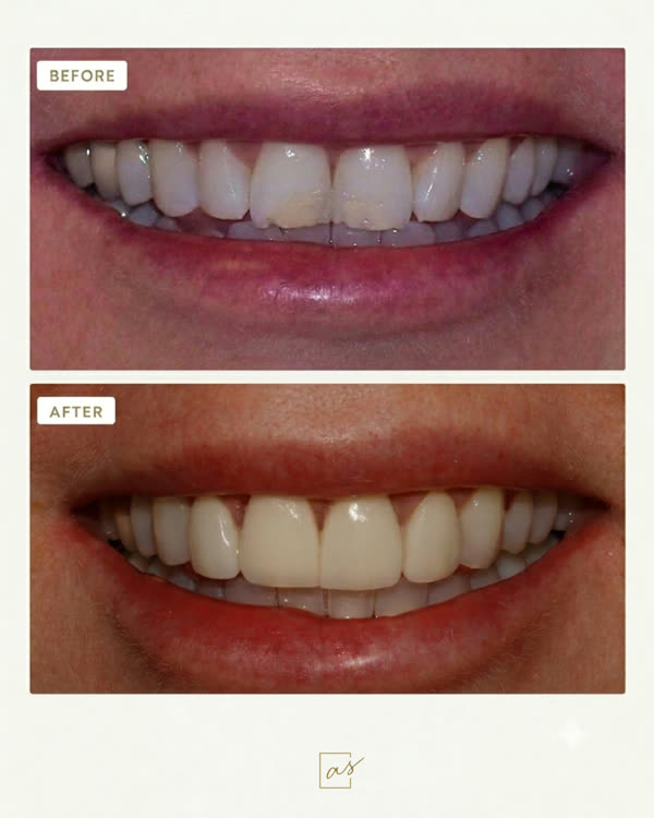 Smile Makeover Before & After Gallery - Patient 6 - Image 1