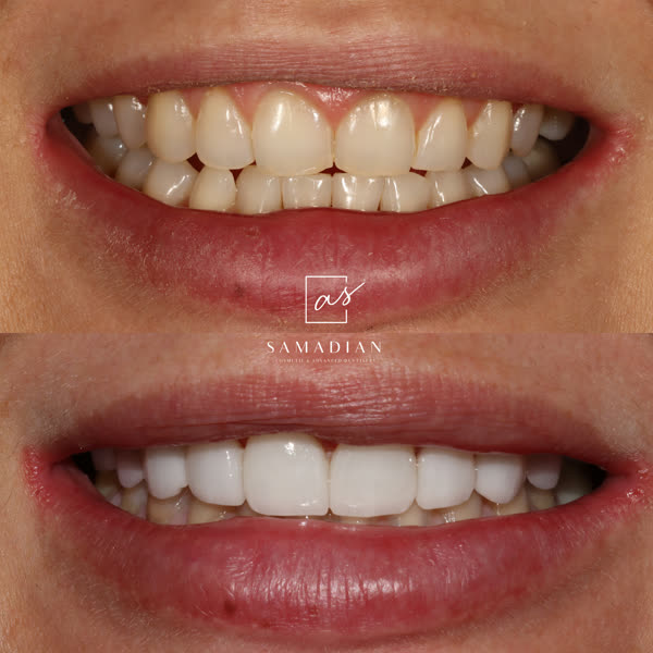 Smile Makeover Before & After Gallery - Patient 11 - Image 1