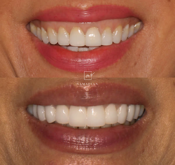 Smile Makeover Before & After Gallery - Patient 14 - Image 1
