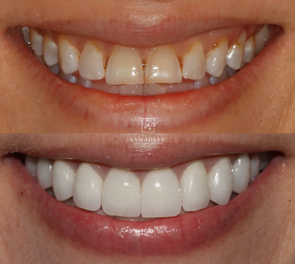 Smile Makeover Before & After Gallery - Patient 16 - Image 1
