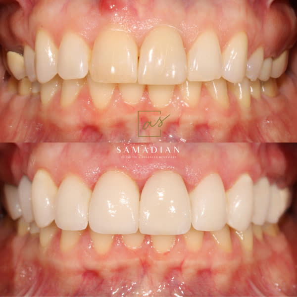 Smile Makeover Before & After Gallery - Patient 17 - Image 1