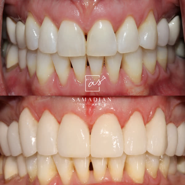 Smile Makeover Before & After Gallery - Patient 18 - Image 1