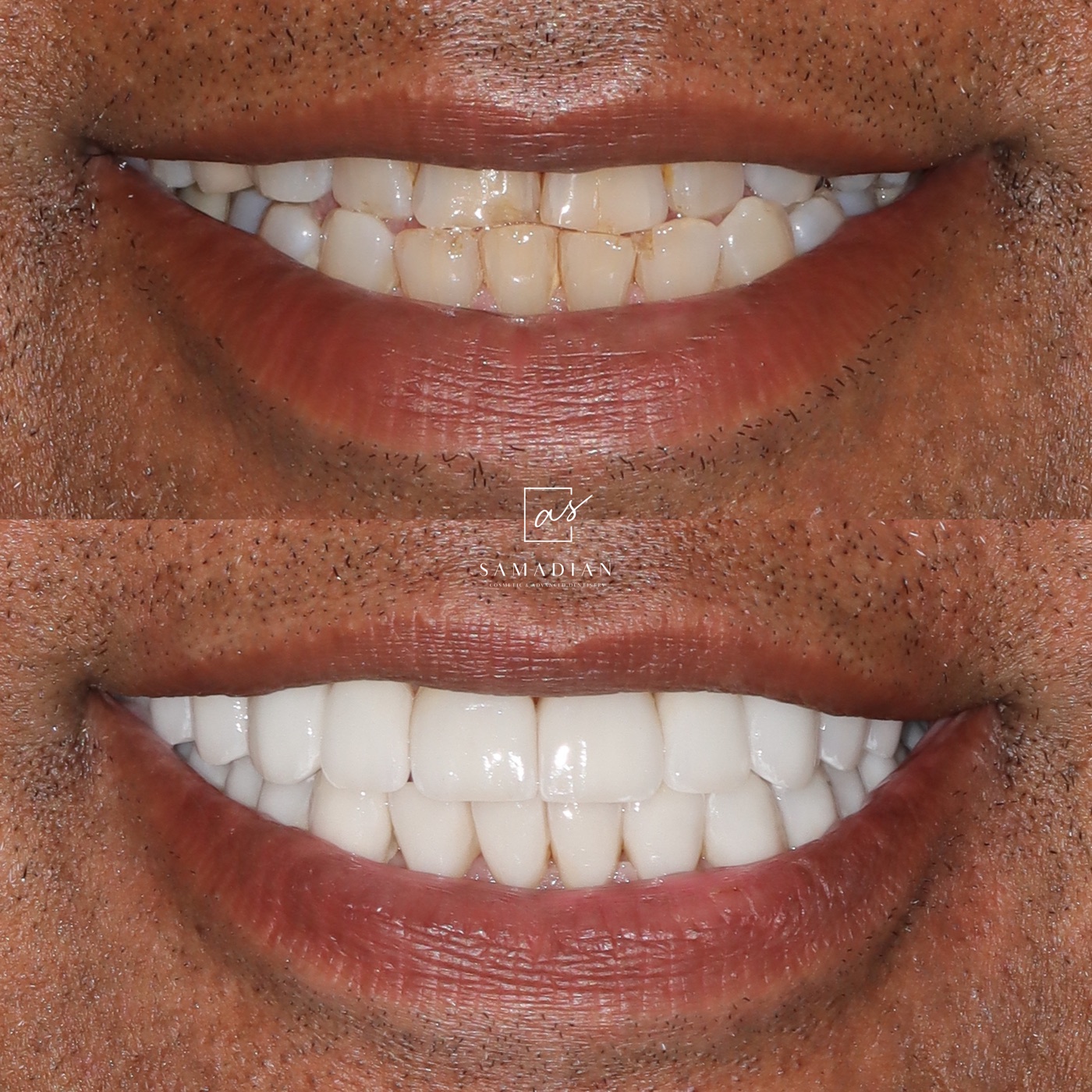 Porcelain veneers before and after - San Francisco patient