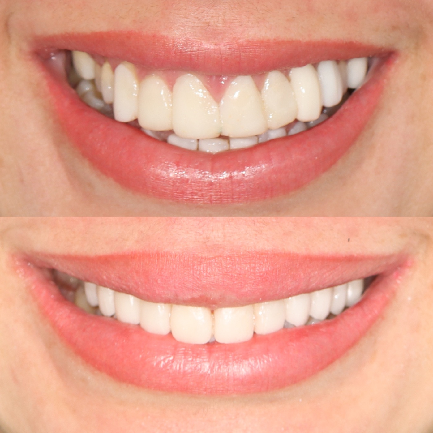 Porcelain veneers before and after - San Francisco patient