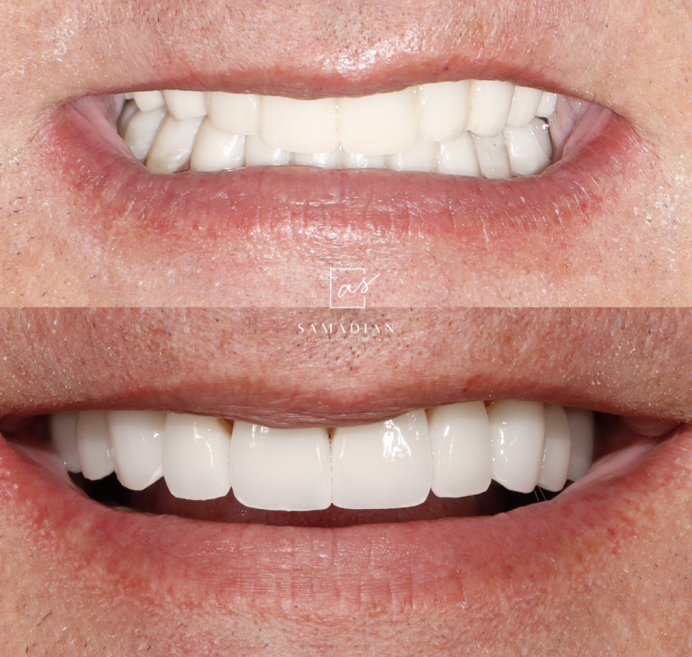 Porcelain veneers before and after - San Francisco patient