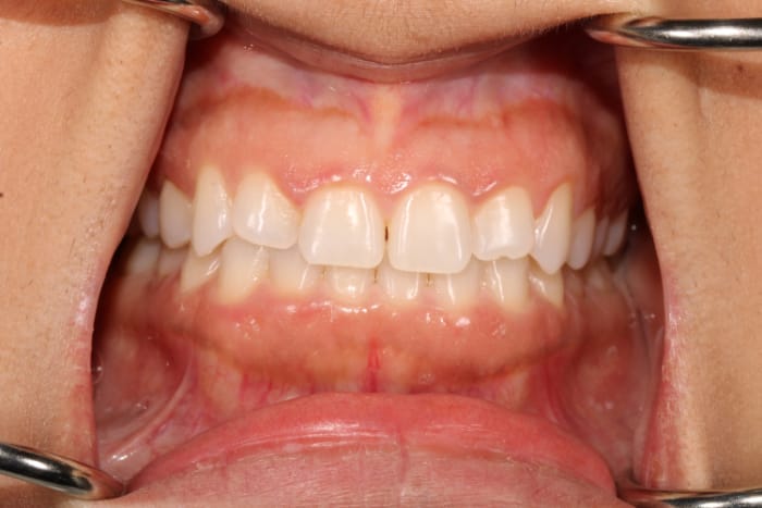Pinhole Surgical Techniquie results in San Francisco with Dr. Samadian