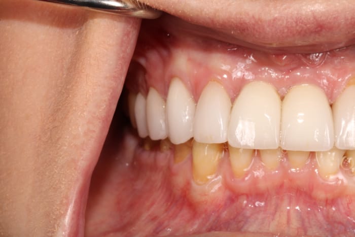 Smile Makeover Before & After Gallery - Patient 39578467 - Image 10