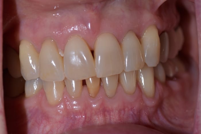 Veneers Before & After Gallery - Patient 39578470 - Image 4