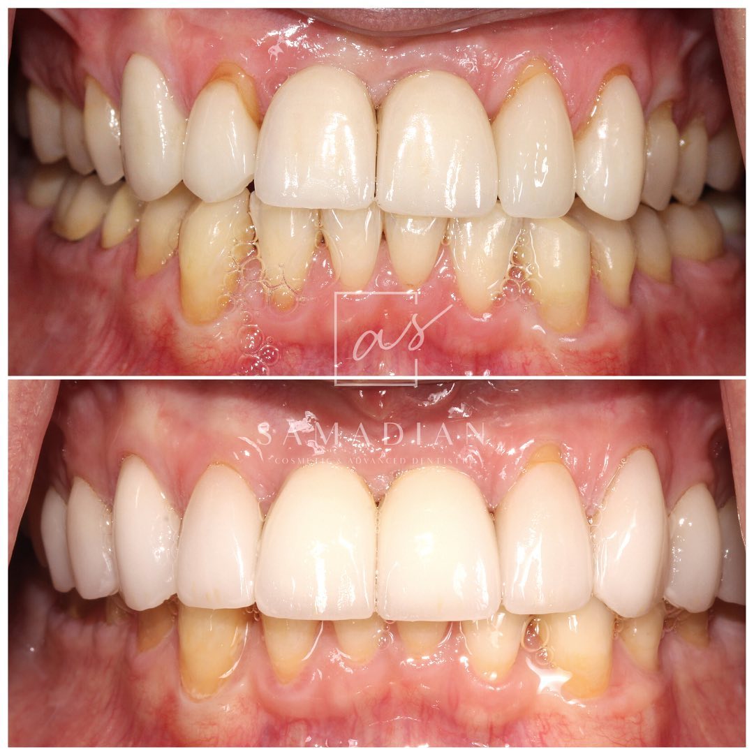 Veneers Before & After Gallery - Patient 56175435 - Image 2