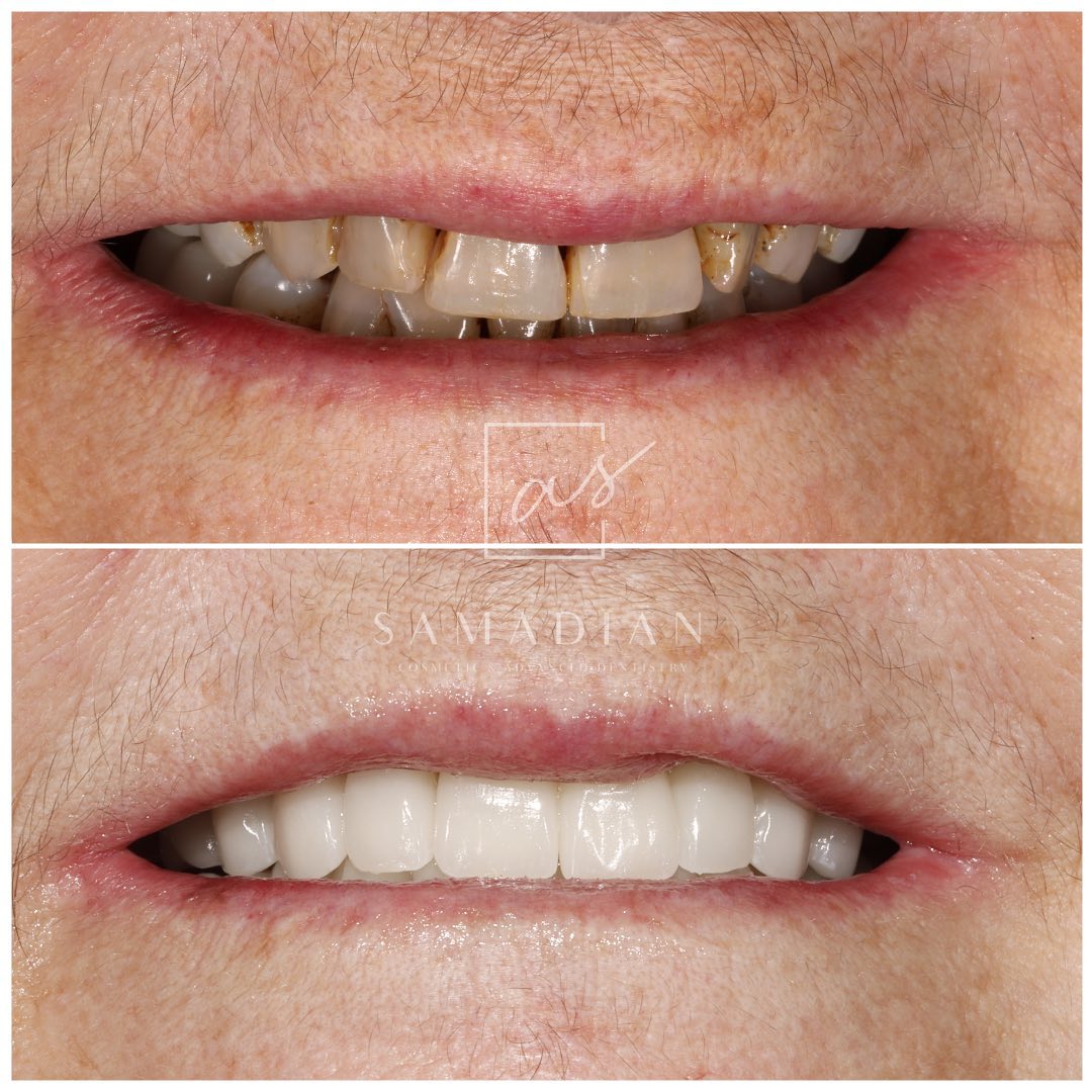 Smile Makeover Before & After Gallery - Patient 54674902 - Image 1